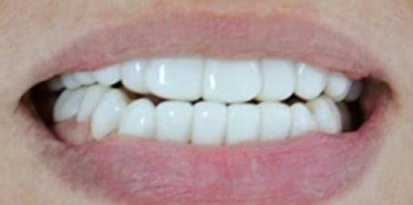 Press On Veneers Before and After - Photo Gallery – TruSmile Veneers