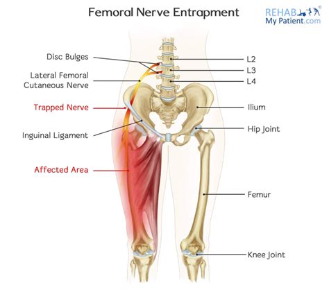 Pin on FEMORAL NERVE PINCHED