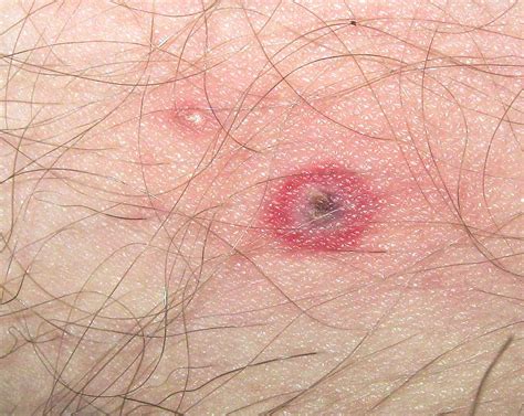 Tick Bite... | Found on my upper inner thigh, along with the… | Flickr