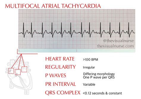 WAP vs. MAT on ECG: What’s the difference? — The Visual Nurse