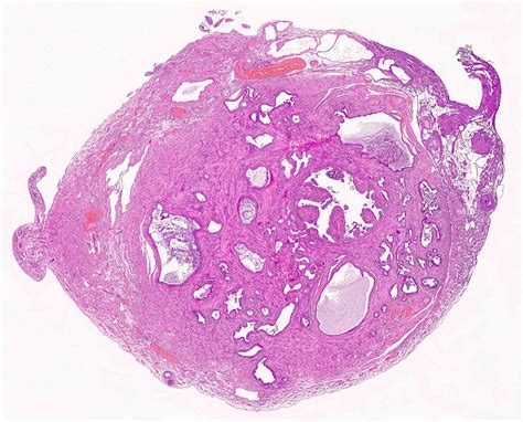 Pathology Outlines - Salpingitis isthmica nodosa