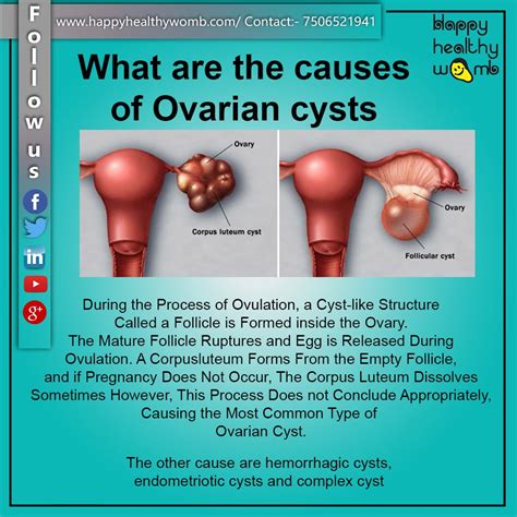 WHAT ARE THE CAUSES OF OVARIAN CYSTS | by Dr. Deepali Lodh | Medium