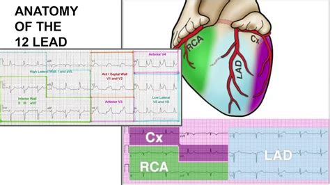 Understanding 12 Lead Part-2: LATERAL STEMI - YouTube