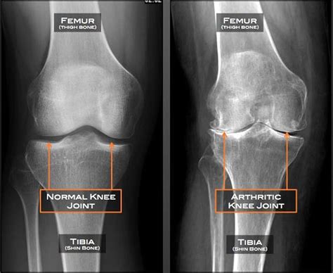 Bol u koljenu: Kako reći ako je trkača koljeno ili osteoartritis ...