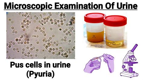 Causes of Pus cells in urine || Pyuria || Microscopic examination of ...