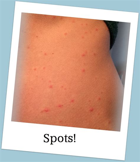 7 Symptoms of Adult Chicken Pox | HealDove