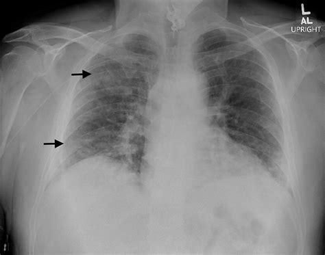 Eosinophilic Pneumonia