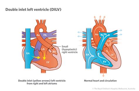 Cardiology : Double Inlet Left Ventricle DILV