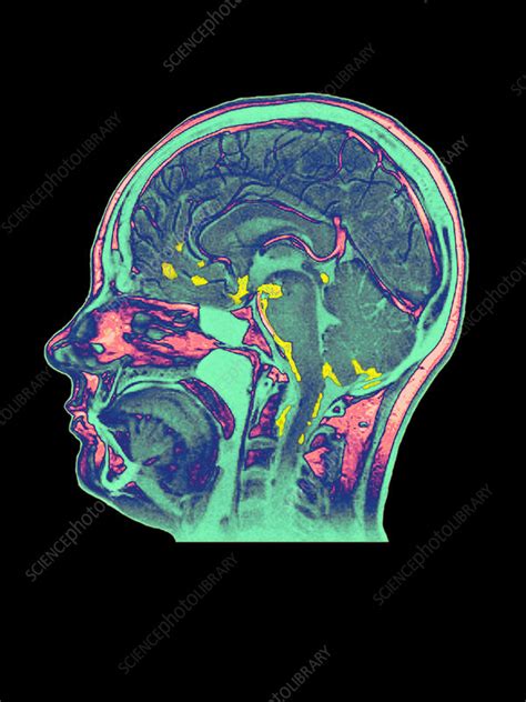 Coloured MRI scan of human brain with meningitis - Stock Image - M210 ...