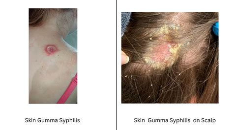 Syphilis Gumma: Pictures, Symptoms, Diagnosis, and Prevention - STD Testing Near Me