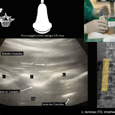 Parasagittal plane oblique US view. | Download Scientific Diagram