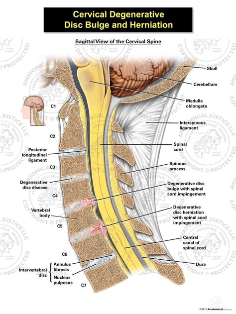 Cervical Degenerative Disc Bulge and Herniation