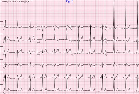 Delta wave | ECG Guru - Instructor Resources