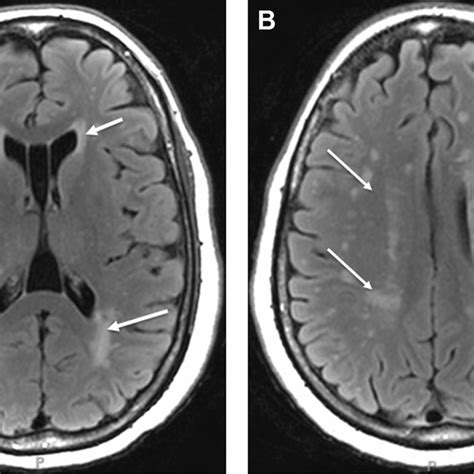 (PDF) Age Differences in Periventricular and Deep White Matter Lesions