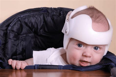 Deformational Plagiocephaly Clinic | Akron Children's