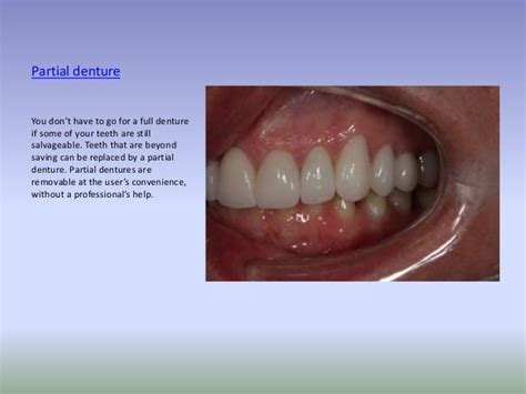 Types of dental prosthesis