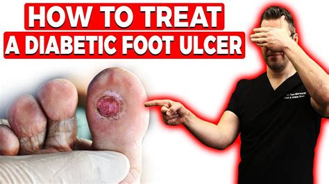 How to Treat a Diabetic Foot Ulcer [Early Signs, Causes & Treatment]