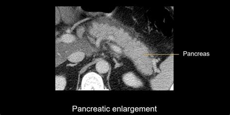 Abdominal CT: interstitial pancreatitis • LITFL • Radiology Library