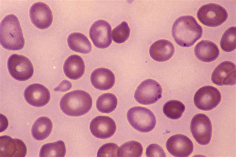 Pin on Anemia/Macrocytic anemia