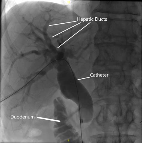 PTC — Hepatobiliary & Upper Gastrointestinal Surgery