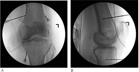 Technical considerations for genicular nerve radiofrequency ablation: optimizing outcomes ...