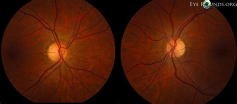 Pituitary Adenoma Causing Compression of the Optic Chiasm: The University of Iowa, Ophthalmology