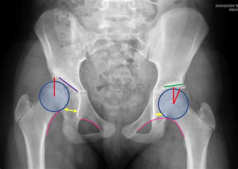 Hip Dysplasia-Adolescent - Description