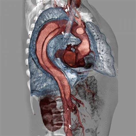 Acute aortic syndromesAcute aortic syndromes | RECAPEM RecapEM