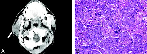 Pleomorphic adenoma causes, symptoms, diagnosis, treatment & prognosis