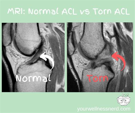 Definitive ACL Injury Guide: Is This The True Cause? | Your Wellness Nerd. Normal ACL MRI vs ...