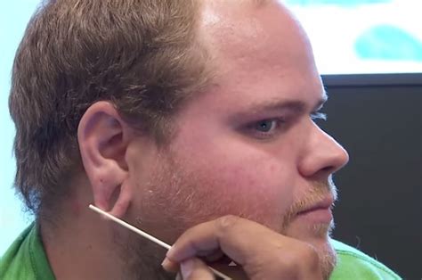 A Guy Got Tired Of His Stretched Earlobes, And Decided To Fix Them With Surgery