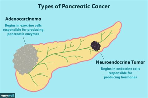 Pancreatic Cancer: Coping, Support, and Living Well