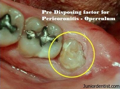 What is Pericoronitis | Treatment and Management of Acute and Chronic Pericoronitis