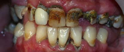 Tooth Decay | North Adelaide Dental Care