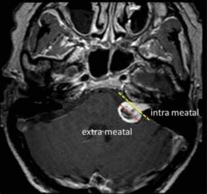 Schwannoma MRI - wikidoc