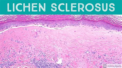 Lichen Sclerosis Histology