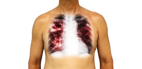 Lung Infection Stock Photos, Images and Backgrounds for Free Download