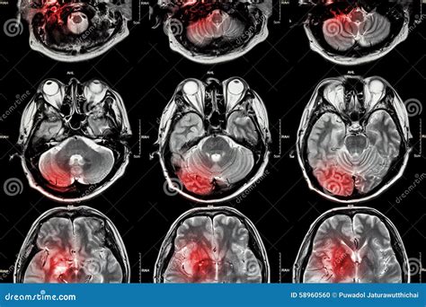 Film MRI ( Magnetic Resonance Imaging ) Of Brain ( Stroke , Brain Tumor ...