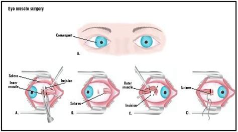 Eye Muscle Surgery - procedure, recovery, blood, pain, complications ...