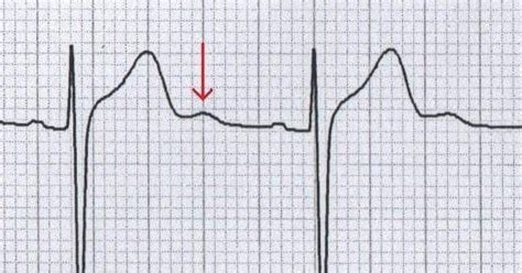 U Wave • LITFL Medical Blog • ECG Library Basics