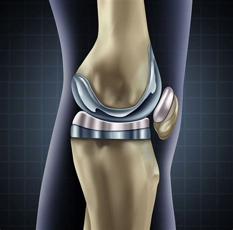 How Is Total Knee Replacement Surgery Performed? | Dr. Amyn Rajani's Blog