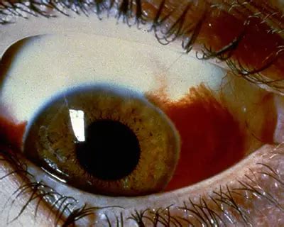 What Is Hyphema? - American Academy of Ophthalmology