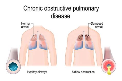 The Difference Between COPD and Emphysema | Kelsey-Seybold Clinic