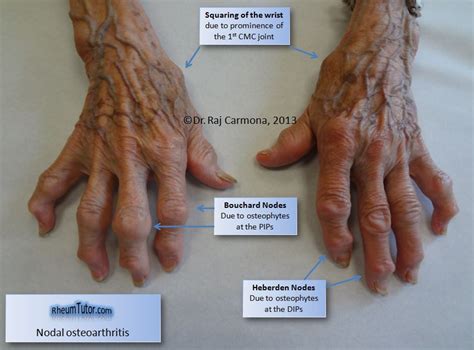 Osteoarthritis · RheumTutor