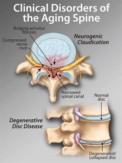 neurogenic claudication | HealthPlexus.net