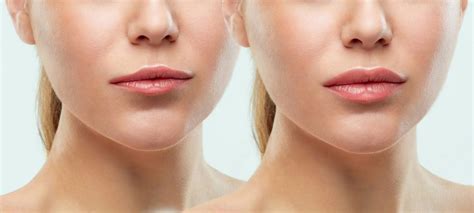 Face Fillers Singapore: Should I get Fillers on my Face?