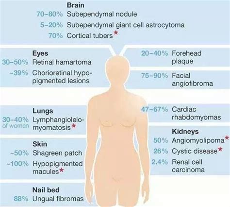 Graphic of Tuberous Sclerosis manifestations | Tuberous sclerosis ...