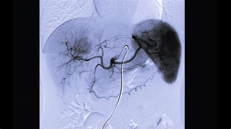 Toce Chemoembolization Procedure That Allows Dose Stock Footage Video (100% Royalty-free ...