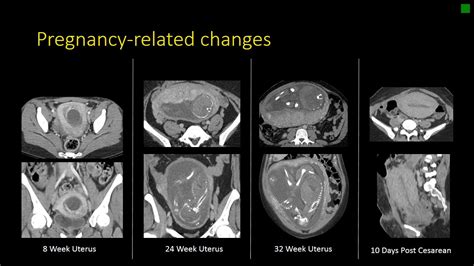 Uterus Anatomy Mri