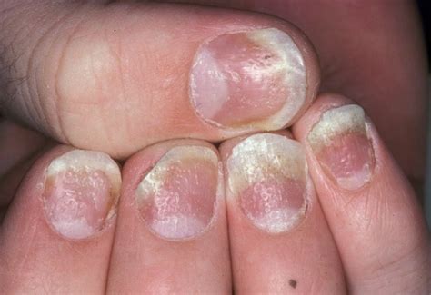 nail psoriasis treatment - pictures, photos